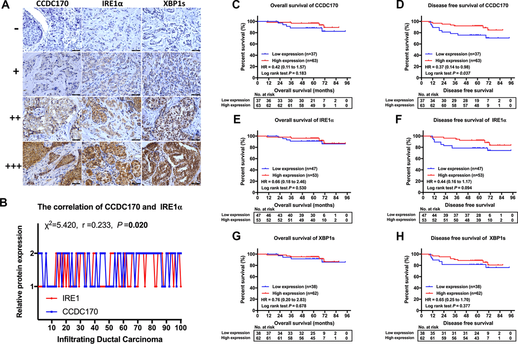 IHC stain and the prognosis value of CCDC170, IRE1α and XBP1s in breast cancer tissues. (A) Representative IHC staining of CCDC170, IRE1α and XBP1s. Scale bar: 50μm. (B) The correlation between CCDC170 and IRE1α levels in breast cancer tissues (r = 0.233, P = 0.020). 1, 2 represented low expression (0-2 staining index) and high expression (3-12 staining index) respectively. n = 100 cases. (C, D) The CCDC170 high-expression group exhibited better DFS (P = 0.037), but no significance in OS (P = 0.183). (E, F) The expression of IRE1α showed no significance in OS (P = 0.530) and DFS (P = 0.094). (G, H) The expression of XBP1s showed no significance in OS (P = 0.678) and DFS (P = 0.377).