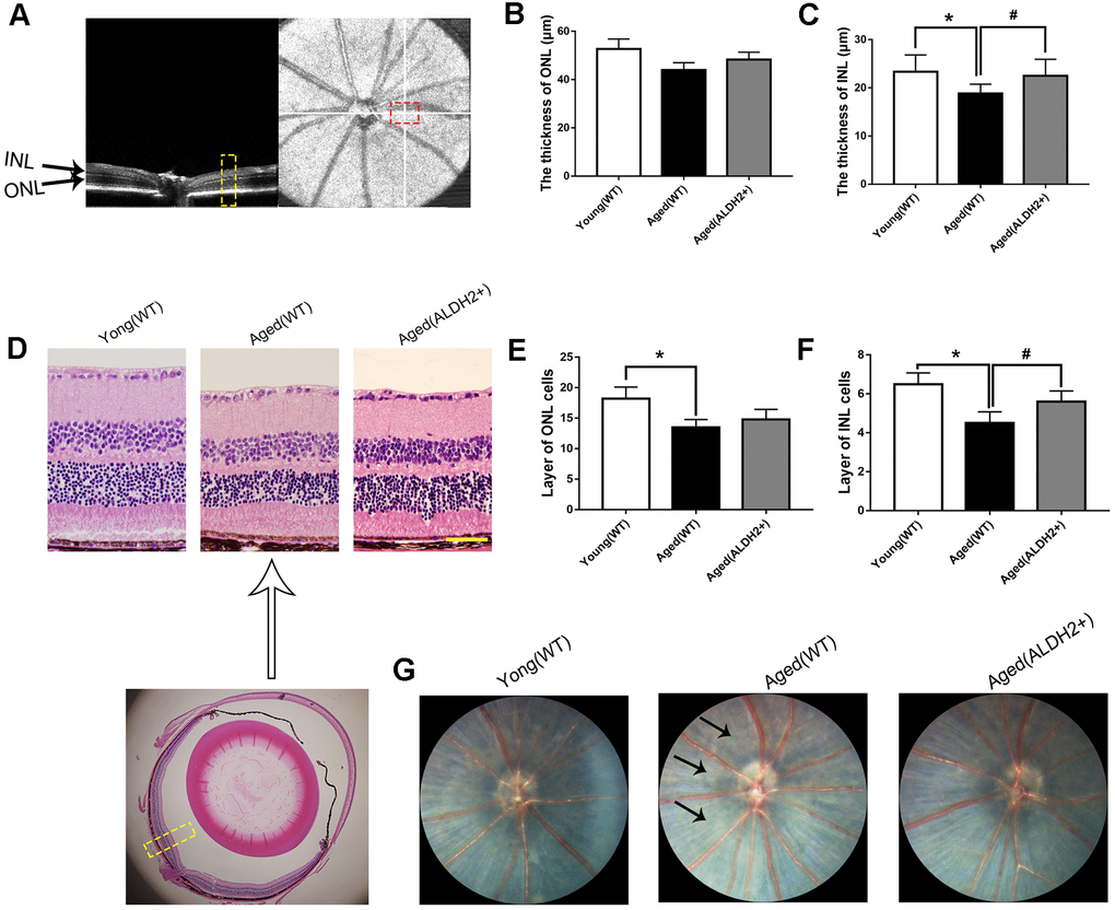 The retinal structures of ALDH2 overexpression aged mice. (A) A typical marked OCT image; (B) The thickness of the ONL; (C) The thickness of the INL; (D) A typical marked HE staining image; (E) The number of ONL cell layers; (F) The number of INL cell layers; (G) The fundus performance in the mice. All analyses were performed in duplicate. Scale bar: 50 μm. Black arrow showed retinal depigmentation change. Yellow box showed retinal structure analysis area. Values are presented as the mean ± SD, n = 6 mice per group. *Pvs young (WT); #Pvs aged (WT).