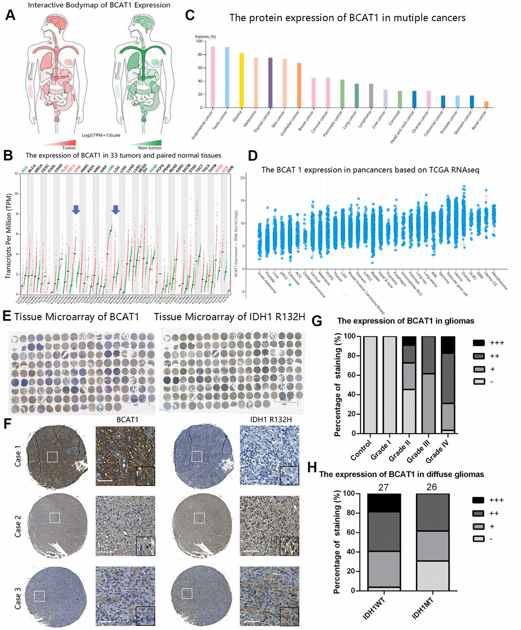 The expression pattern of BCAT1 in pan-cancer and gliomas. (A, B) The mRNA expression profiles of BCAT1 in 33 tumors and paired normal tissues were shown in bodymap and dot plot. (C) The expression pattern of BCAT1 protein in multiple cancer tissues from the Human Protein Atlas. (D) The BCAT1 expression in multiple cancer tissues from TCGA RNAseq. (E) The entire immunohistochemical staining of BCAT1 and IDH1 R132H in tissue microarray. (F) Representative images of BCAT1 and IDH1 R132H staining in three cases of glioma patients. (Case1: GBM, WHO Grade IV; Case2: Anaplastic oligodendroglioma, WHO Grade III; Case3: GBM, WHO Grade IV) (Scale: 100um) (G) Quantitative analysis of BCAT1 immunohistochemical staining in different grades of gliomas. (H) Quantitative analysis of IDH1 R132H immunohistochemical staining in IDH1 wild-type and mutant diffuse gliomas.