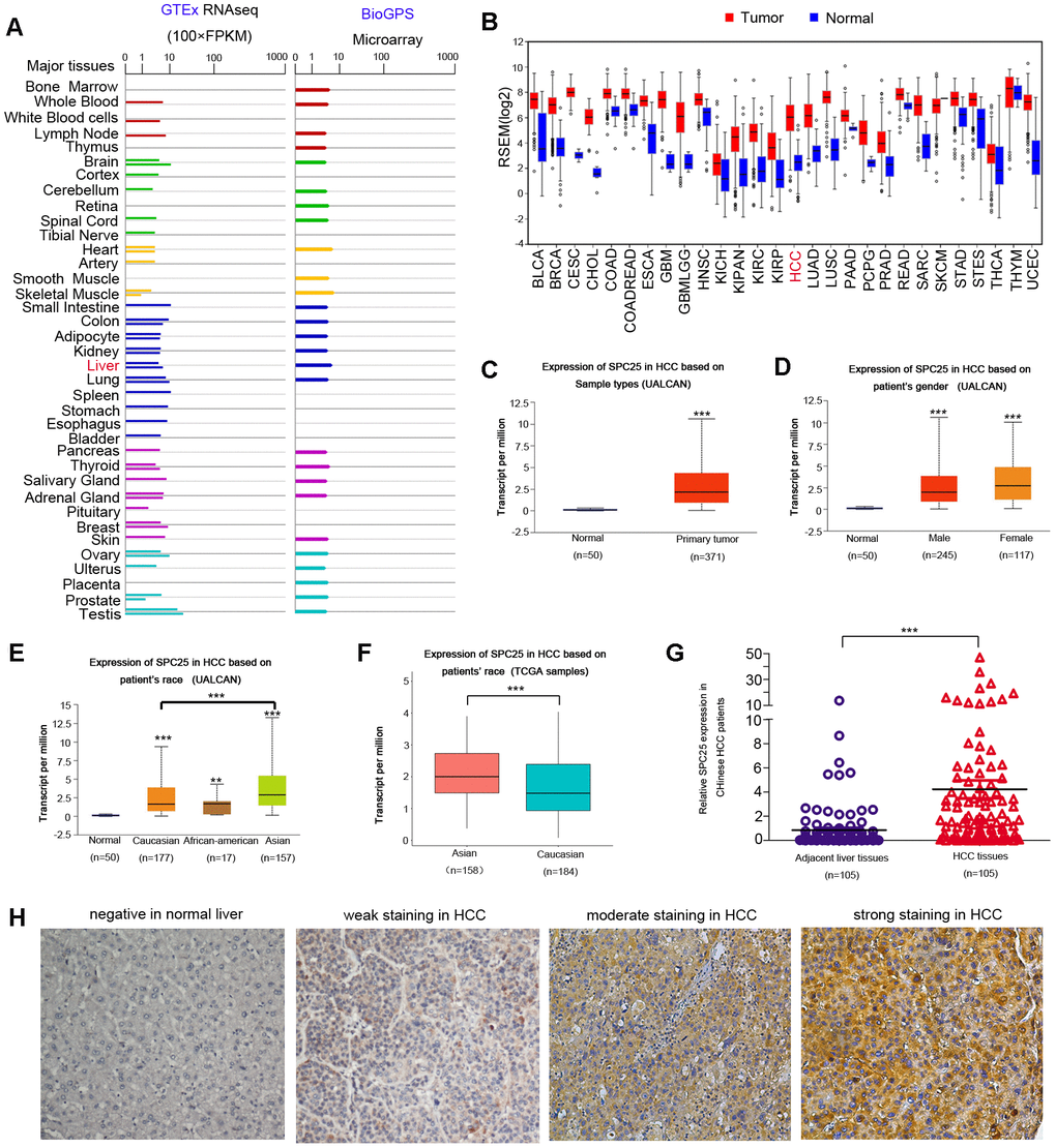 SPC25 expression in normal human tissue, human tumors, and in HCC. (A) SPC25 mRNA expression in normal human tissues. GTEx: The Genotype-Tissue Expression project; FPKM: Fragments Per Kilobase per Million. (B) SPC25 mRNA expression in multiple human cancers is higher compared to corresponding normal tissues. RPKM: Reads Per Kilobase per Million. (C) SPC25 mRNA is significantly overexpressed in HCC samples compared to normal controls, according to UALCAN. (D) Both male and female HCC patients showed a higher SPC25 transcriptional level than normal controls, according to UALCAN. (E) UALCAN analysis showed that SPC25 mRNA levels are significantly higher among Caucasian, African-American, and Asian HCC patients than normal controls. Besides, SPC25 showed a relatively higher transcriptional level in Asian patients in contrast with Caucasian patients. (F) SPC25 mRNA expression in Asians HCC patients is significantly higher than that in the Caucasian HCC patients based on TCGA HCC samples screened by race. (G) SPC25 mRNA is significantly overexpressed in Chinese HCC tumor specimens vs. corresponding adjacent normal liver tissue. (H) Representative images of SPC25 protein expression in normal liver and HCC samples from Chinese patients. (*P 