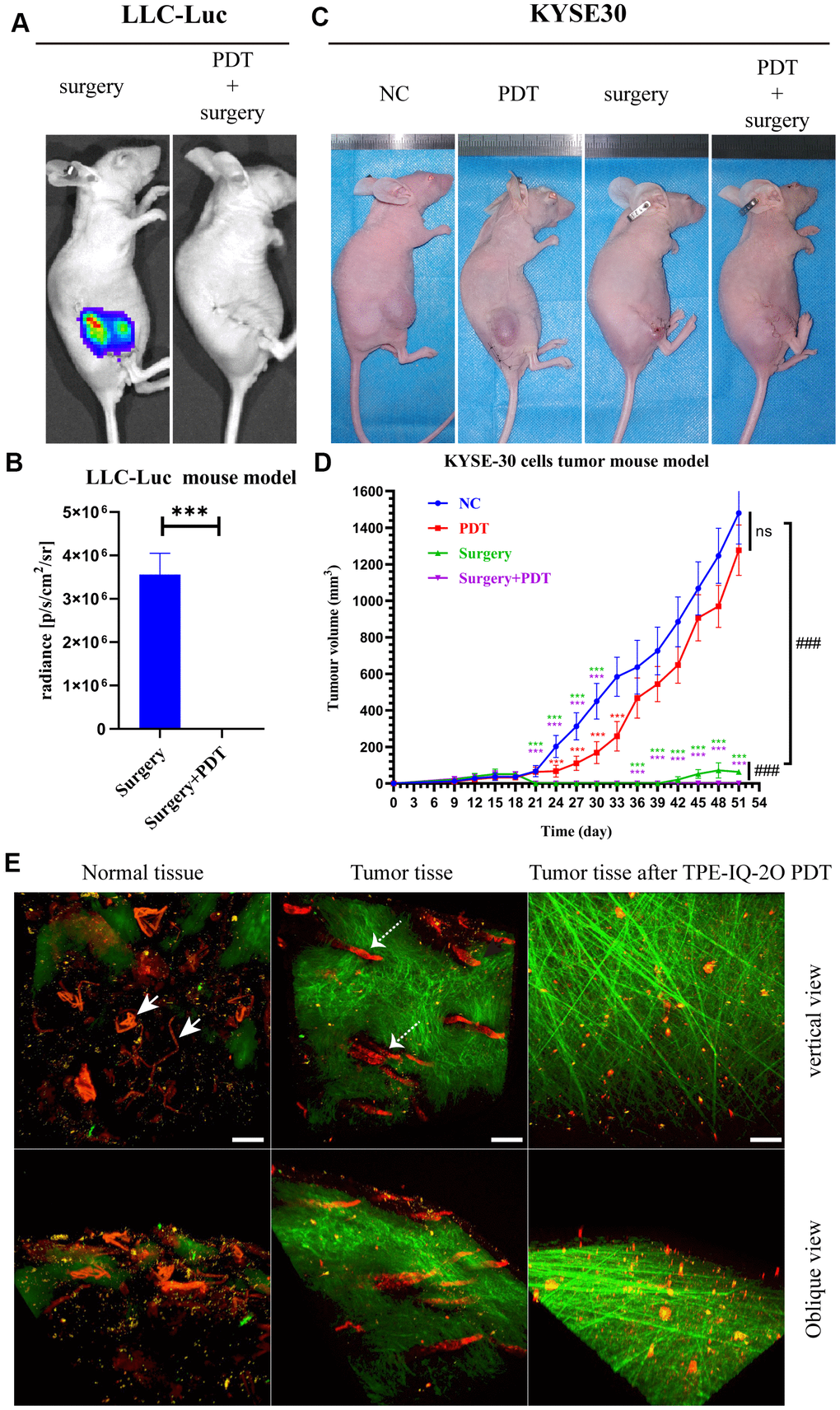 TPE-IQ-2O PDT combined with surgery can effectively remove the residual tumor focus at the incisal margin and reduce tumor recurrence. (A, B) In vivo bioluminescence imaging and measurement of the LLC-Luc cell tumor mouse model after surgery alone or combined with intraoperative PDT therapy on the 17th day. n=3 mice/group. Data are expressed as the mean±s.d., ***p C, D) A KYSE-30 cell tumor mouse model and tumor volumes in the control group, PDT alone group, surgery alone group and surgery combined with intraoperative PDT group. n=5 mice/group. Data are expressed as the mean±s.d., ***p p E) Evaluation of tumor vessels and the stroma after TPE-IQ-2O PDT in the KYSE30 cell subcutaneous tumor model (the white solid arrow shows subcutaneous vessels in normal skin, and the white dashed arrow shows tumor vessels; λex: 1040 nm, λem: 575-610 nm; the green signal represents the stroma, λem: 805 nm; the red signal represents vessels, scale bar=20 μm). (PDT represents the abbreviation of TPE-IQ-2O PDT in this figure).