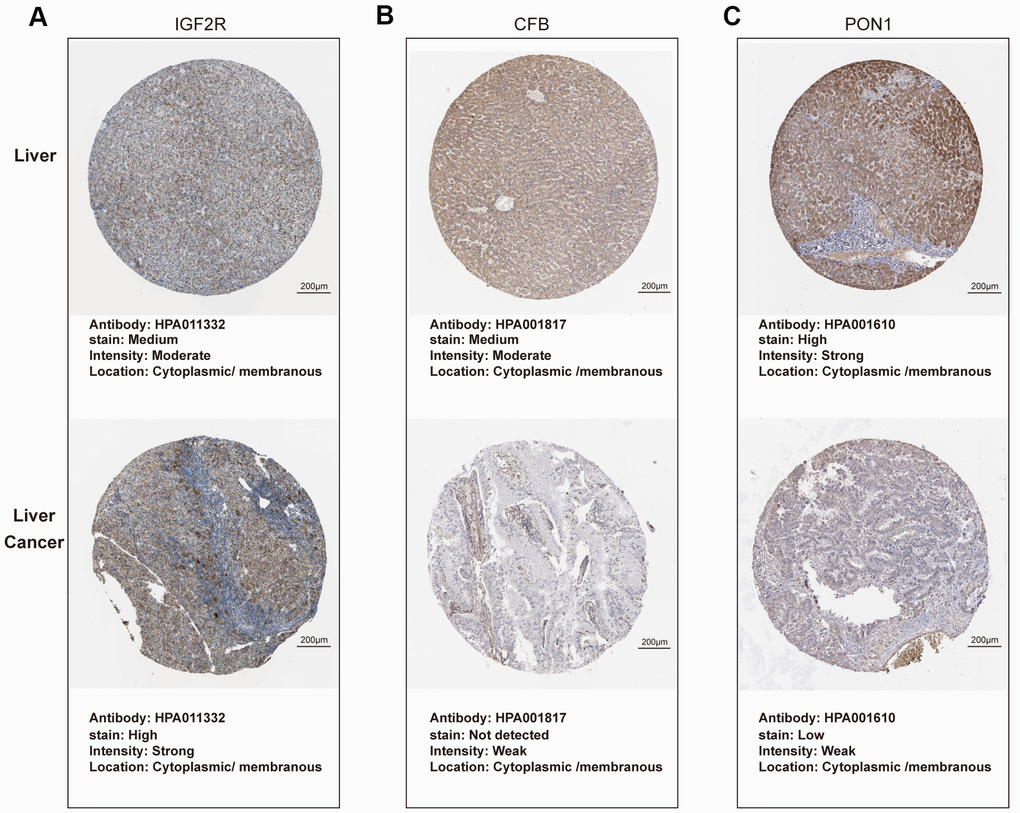 Protein expression of candidate genes in HCC tissues and normal liver tissues (Human Protein Atlas). (A–C) Representative immunohistochemistry images of IGF2R, CFB, PON1 in HCC tissues, and normal liver tissues, respectively.