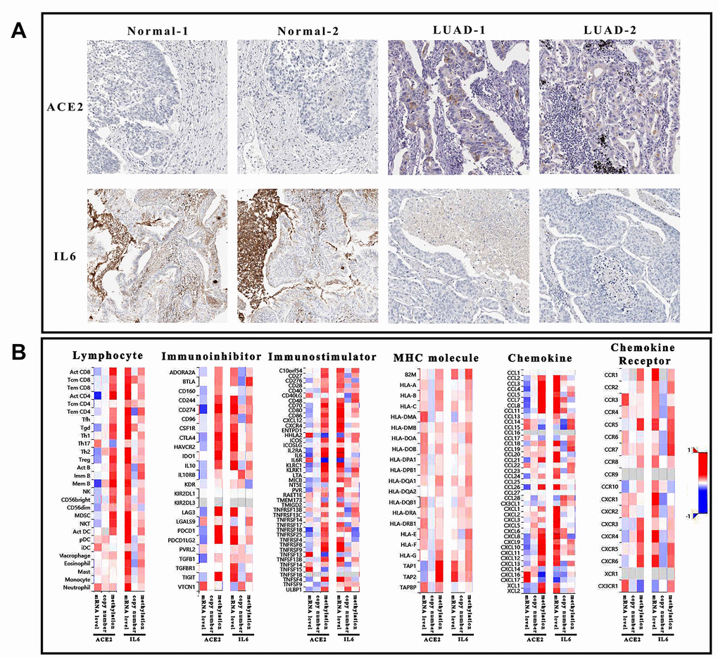 Immunological analysis of ACE2 and IL6. (A) The pathological sections of tumor tissue and normal tissue which was stained by ACE2 and IL6 antibody. Each group has 2 duplicate samples. (B) The heatmap showed the correlation of 6 immunological factors (lymphocyte, immune-inhibitor, immune-stimulator, MHC molecule, chemokine, and chemokine receptor) vs. mRNA expression, copy number and methylation of ACE2 and IL6.