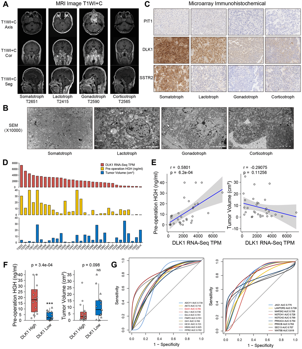 Clinical relevance of DLK1 in somatotroph adenomas. (A) MR images of PitNET patients. (B) Transmission electron microscope of PitNET patients. (C) Immunohistochemistry image of DLK1, PIT1 and SSTR2 in PitNET patients. 400×. (D) The TPM values of DLK1, serum GH levels and tumor volumes in 31 somatotroph adenomas. (E) Correlation of DLK1 and serum GH, tumor volume. (F) There was statistic difference of GH level between patients with high DLK1 and low DLK1, not tumor volume. (G) ROC curve. HRAS (0.825), WNT5B (0.819), Notch2 (0.799), DLK1 (0.795) and ITPR2 (0.782) were filtered in PI3K/AKT/mTOR pathway, Notch pathway and growth hormone synthesis, secretion and action. *compare to control group PPP