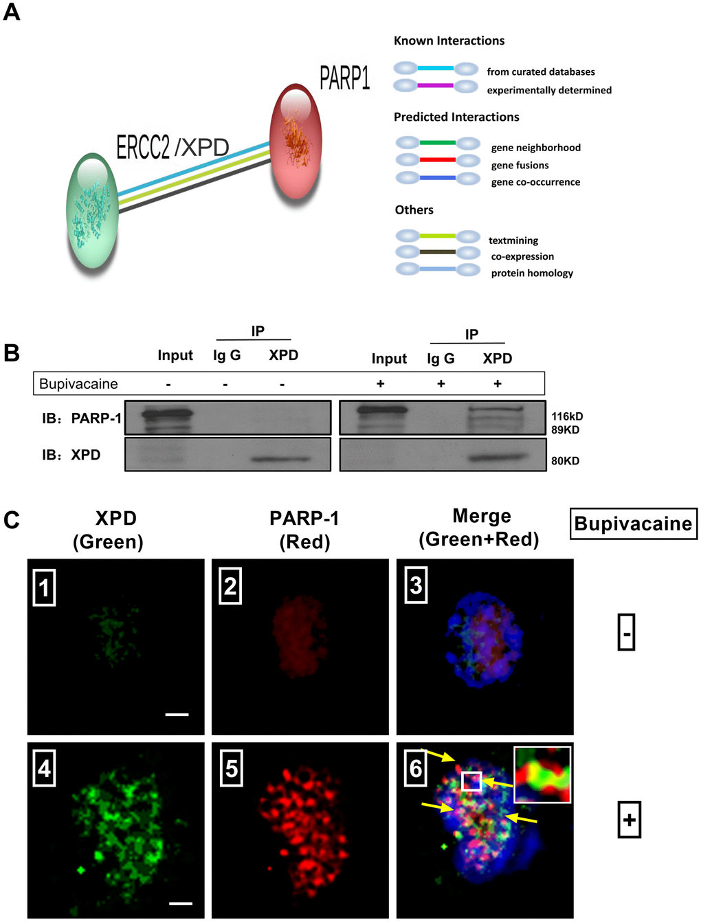 Possible existence of a novel interaction between XPD and PARP-1 in repairing the oxidative DNA damage caused by bupivacaine. Our previous study and iTRAQ results of the current study both suggested that XPD/ERCC2 also participated in the oxidative DNA damage of neurons caused by bupivacaine. But the interaction between PARP-1 and XPD is still unclear. Firstly, we identified the interaction between PARP-1 and XPD(ERCC2) using the STRING version 11.0 Program. (A) Combined screenshots came from the STRING website. Colored lines between the proteins indicate the various types of interaction evidence (according to the STRING website for color legend). Protein nodes that are enlarged indicate the availability of 3D protein structure information. No direct evidence or experimental data is available to confirm whether there exists an interaction between PARP-1 and ERCC2/XPD. For further verification, immunoprecipitation was applied to SH-SY5Y cells exposed to bupivacaine, and a strong interaction between XPD and PARP-1 was observed (B). Further, Immunofluorescence staining showed the colocalization (C ⑥, the yellow arrows) of XPD (Green) and PARP-1 (Red) following bupivacaine treatment in SH-SY5Y cells. Nuclei were stained with DAPI (blue). Bars, 5μm. Representative results of three experiments are shown.