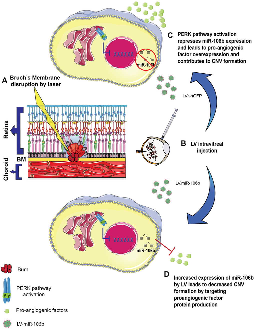 Schematic of miR-106b impact on CNV in mouse laser burn model. (A) Bruch's membrane disruption following laser burn. (B) Intravitreal injection of LV.shGFP or LV.miR-106b. (C) PERK activation represses miR-106b expression and leads to pro-angiogenic factor overexpression, contributing to CNV formation. (D) Increased expression of miR-106b by LV leads to decreased CNV formation by targeting proangiogenic factor protein production. (CNV: choroidal neovascularization, LV: lentivirus).