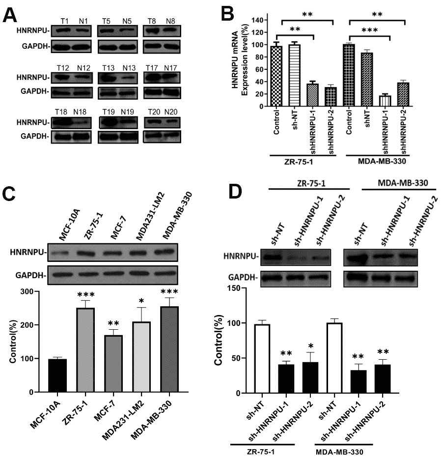 HNRNPU expression is upregulated in BRCA cell lines and clinical tumor samples. Altering expression of HNRNPU proteins in clinical tumor samples (A) and four human BRCA cell lines (B), as determined via western blot analysis. Glyceraldehyde 3-phosphate dehydrogenase was used as the control. ZR-75-1 and MDA-MB-330 cells were transfected with shRNA and the mRNA (C), and protein (D) expression levels of HNRNPU were measured via reverse transcription quantitative real-time polymerase chain reaction and western blotting. *P P P 