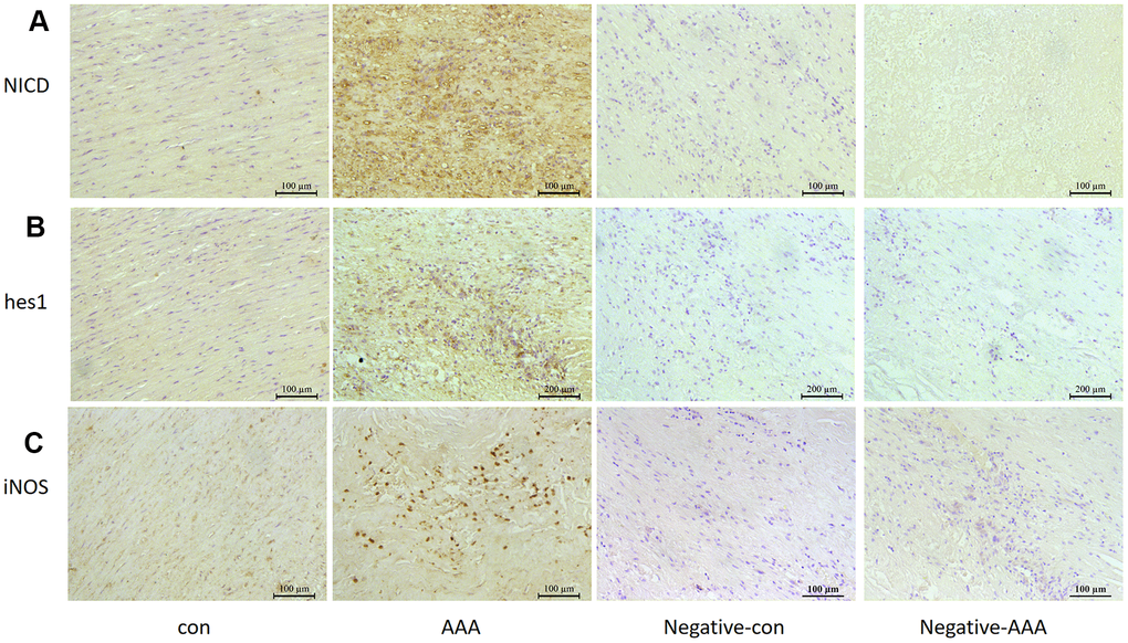 Notch signaling and M1 polarization were activated in human aorta of AAA. Control, Patients with non-abdominal aortic aneurysm; AAA, Patients with abdominal aortic aneurysm; Negative-con, Negative control group of patients with non-abdominal aortic aneurysm; Negative-AAA, Negative control group of patients with abdominal aortic aneurysm. Immunohistochemistry of (A, B) the protein expression of NICD and hes1 in patient aortas and (C) the protein expression of M1-type macrophage marker iNOS in patient aortas.