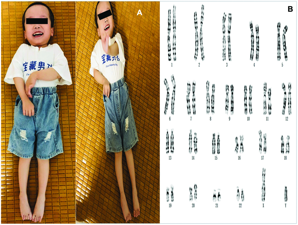 (A) The photos of the proband. (B) Karyotyping analysis of the fetus. Chromosomal analysis on cultured amniocytes rvealed a normal male fetus (46,XY).