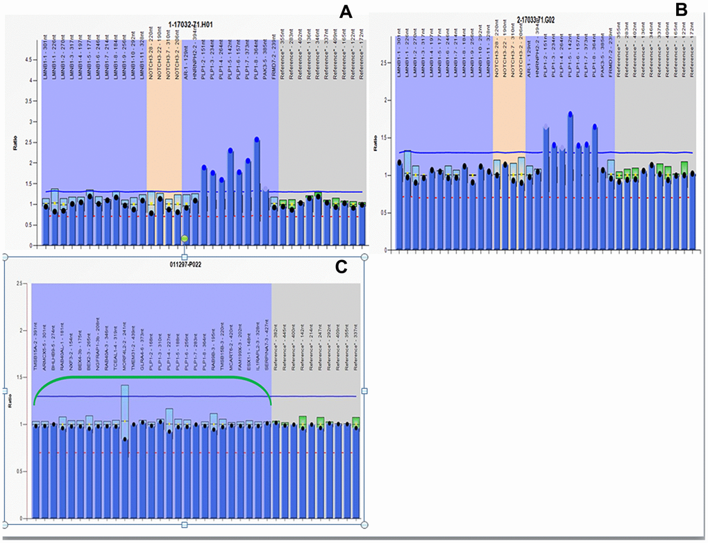 MLPA results. All peaks corresponding to the 7 exons of the PLP1 gene in the proband and his mother are higher than peaks in female control due to PLP1 gene duplication. The relative copy numbers for each PLP1 exon were shown. Fluorescence signal intensity between 0.7 and 1.25 is generally considered normal result. (A) MLPA results of the proband. (B) MLPA results of the pregnant mother. (C) MLPA results of the fetus.