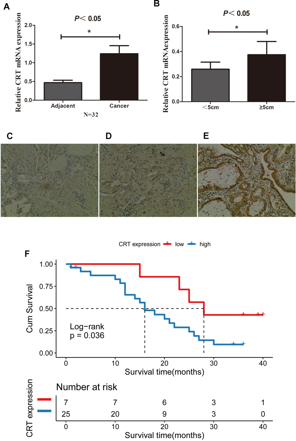 CRT is upregulated in GBC tissues and is associated with poor prognosis. (A) Relative mRNA expression of CRT in 32 paired adjacent and cancer tissues from patients with GBC. (B) Relative expression of CRT in tumor with a size C) IHC staining results for CRT in cholecystitis samples. (D) IHC staining results for CRT in adjacent peri-cancerous tissues. (E) IHC staining results for CRT in GBC cancer tissues (magnification x100). (F) Kaplan-Meier analyses of overall survival in 32 GBC patients based on CRT expression level of GBC tissues.*P