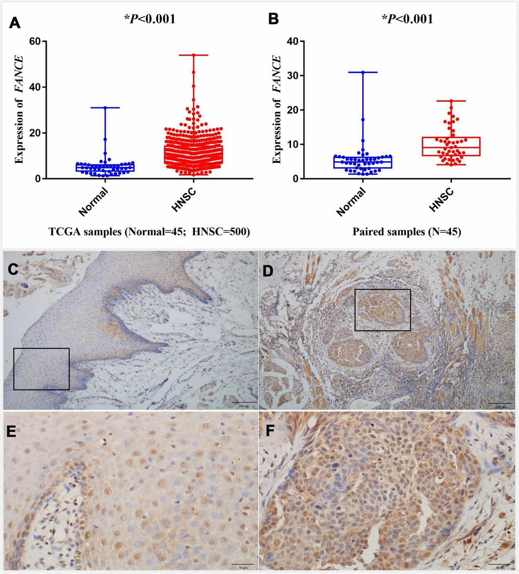 Analysis of differential expression of FANCE in HNSC. Representative IHC staining (200x) performed for detecting the expression of FANCE from adjacent normal tissues and tumor-tissue specimens of HNSC patients from human protein atlas (https://www.proteinatlas.org/). (A) FANCE expression was compared between HNSC tissues and normal tissues based on the TCGA database. FANCE expression in HNSC (n = 500) was significantly increased than that in normal patients (n = 45). (B) The level of FANCE expression was compared between the paired samples. Matching cancer tissues and adjacent normal tissues of the same patient also showed that FANCE expression was significantly up-regulated in cancer tissues. (C–F) C and E showed normal tissue, while D and F were HNSC tissue. Immunohistochemical staining was performed to detecting the expression of FANCE in adjacent normal tissues (C, x200 and E, x400) and tumor tissue specimens (D, x200 and F, x400) of patients with HNSC.