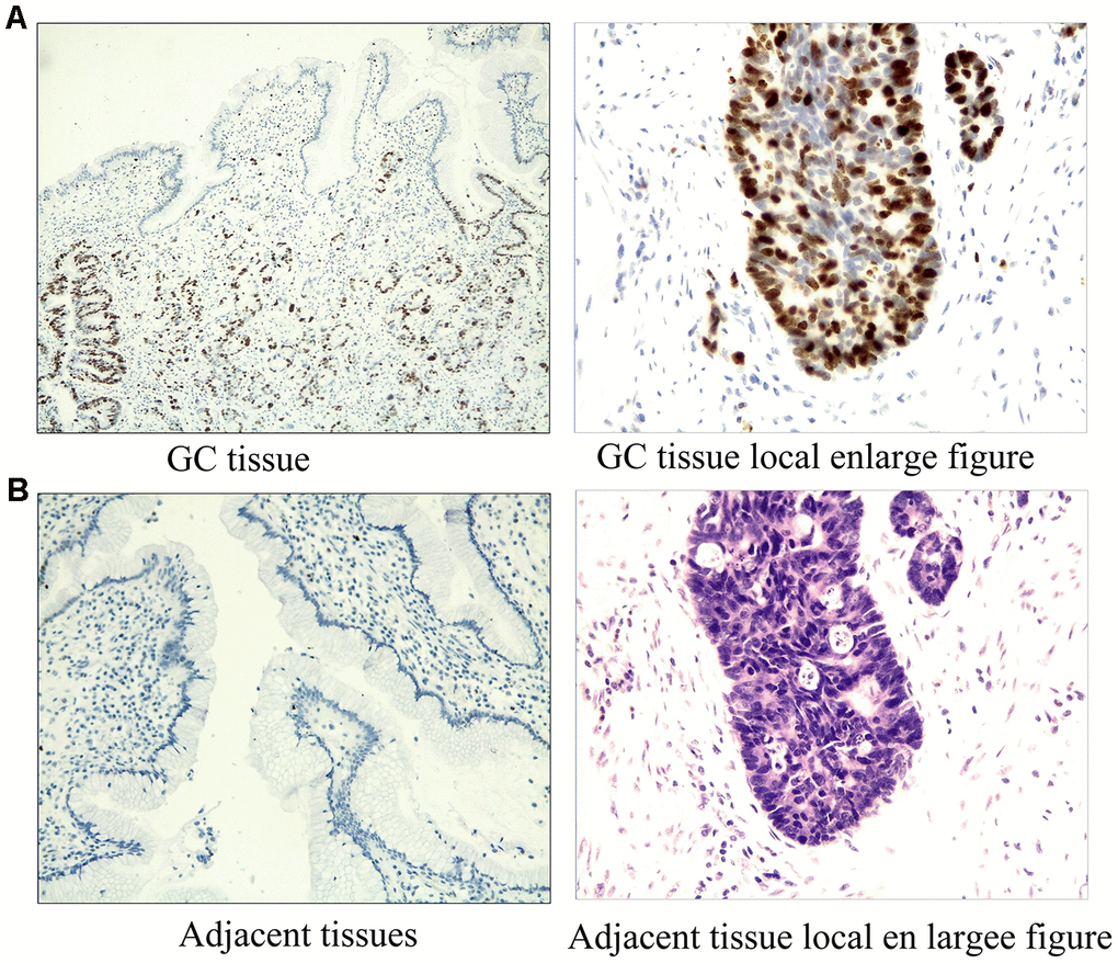 Immunostaining results of ERRα in GC tissues and adjacent tissues. (A) Immunostaining results of ERRa in GC tissues; (B) Immunostaining results of ERRa in adjacent tissues.