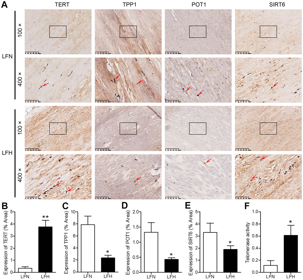 Analysis of SIRT6 and telomerase activity in human ligamentum flavum samples. (A) TERT, TPP1, POT1, and SIRT6 levels in non-hypertrophic and hypertrophic ligamentum flavum (LFH and LFN, respectively) tissue samples were assessed via immunohistochemistry (IHC). Scale bar = 200 μm or 50 μm. (B–E) Quantitative analysis of the percent area positive TERT (B), TPP1 (C), POT1 (D) and SIRT6 (E) staining area. (F) Telomerase activity in LFH and LFN tissue samples as represented by telomerase signal (optical density). n = 30. *pp