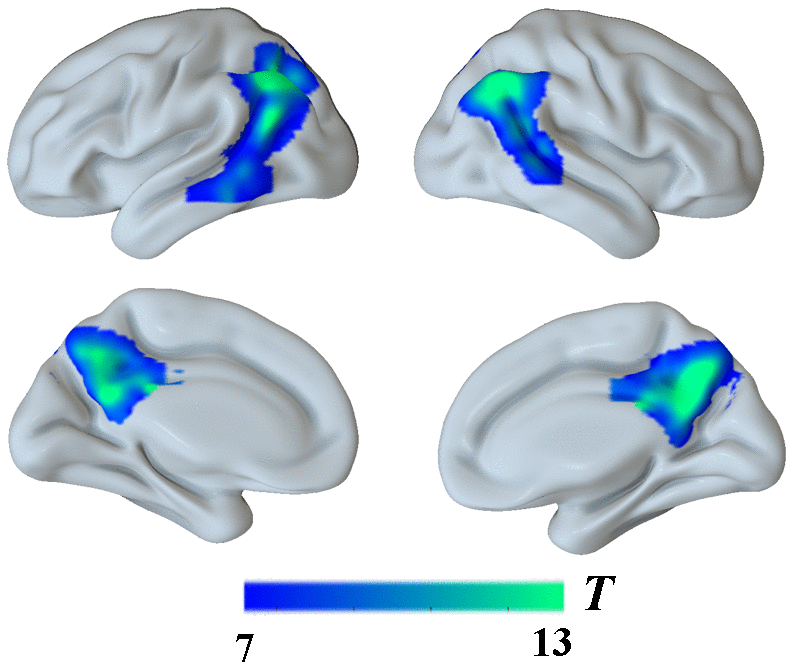 Group differences in18F-FDG SUVR by using whole-brain confirmatory analysis between the AD group and the NC group. Significant reduced metabolism in AD patients was shown in cold blues.