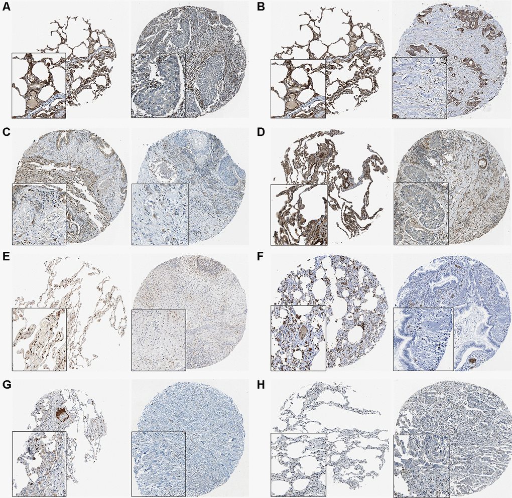 The THPA results of 8 target genes in normal and tumor tissues. (A) AMOTL2. (B) BCL2L2. (C) CACDH1. (D) MSRB3. (E) NFIB. (F) S1PR2. (G) SORT1. (H) SRF.