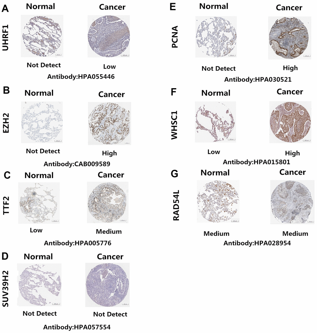 Epigenetic regulatory protein expression in NSCLC and normal lung tissues. The Human Protein Atlas database analysis results show the expression levels of UHRF1, EZH2, TTF2, PCNA, WHSC1, SUV39H2 and RAD54L proteins in NSCLC and normal lung tissues. UHRF1, EZH2, TTF2, PCNA, and WHSC1 protein levels were significantly upregulated in NSCLC tissues (A–C, E–F). SUV39H2 and RAD54L proteins were similar in the NSCLC and normal lung tissues (D, G).