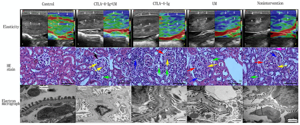 Elastic imaging, H&E staining, and electron micrograph analyses of right kidney parenchymal podocytes in rats. Assessment of rat renal parenchymal elasticity. Control group: The majority of the region of interest (arrow) is green, with a small portion being red; score = 1. CTLA-4-Ig + UM group: The majority of the region of interest (arrow) is green, with some areas being red and blue; score = 2. CTLA-4-Ig group: The majority of the region of interest (arrow) is green, with some areas being red and blue; score = 2. UM group: The region of interest (arrow) is primarily blue with some green; score = 3. Non-intervention group: The region of interest (arrow) is primarily blue with some green; score = 3. H&E staining of renal parenchymal tissue samples. -Control group: No glomerular capillary cavity changes, cellular proliferation, or basement membrane thickening are evident, with clear glomerular balloon; -CTLA-4-Ig + UM group: Glomerular volume is slightly enlarged and the glomerular basement membrane is partially thickened (black arrow), with slight cellular proliferation, with a small amount of hyaline substance deposition (yellow arrow) and vacuolated degeneration of the renal tubular epithelial cells (green arrow); CTLA-4-Ig group: Glomerular basement membrane thickening is evident (red arrow), with cellular proliferation, a small amount of hyaline substance deposition (yellow arrow), narrowing of the partial capillary lumen, marked vacuolated degeneration of the renal tubular epithelial cells (green arrow), and interstitial lymphocyte infiltration (blue arrow); UM group: Glomerular volume enlargement and basement membrane thickening are evident (red arrow), with marked cellular proliferation, flaky hyaline substance deposition (yellow arrow), vacuolated degeneration of renal tubular epithelial cells (green arrow), and narrowing of the capillary lumen (blue arrow); Non-intervention group: Glomerular volume enlargement and basement membrane thickening are evident (red arrow), with cellular proliferation, flaky hyaline substance deposition (yellow arrow), vacuolated degeneration of the renal tubular epithelial cells (green arrow), narrowing of the capillary lumen (blue arrow), and hyalinosis of the glomerular wall (pink arrow). Assessment of podocyte ultrastructural features via TEM. (The splicing is used to join together two parts of the same TEM image due to the limitation of the field of view). Control group: Podocytes exhibit a uniform arrangement without any fusion or loss; CTLA-4-Ig + UM group: Podocyte synapses appear disorderly, without obvious fusion or loss; CTLA-4-Ig group: Podocyte synapse structures are still present, but with visible evidence of fusion (black arrow); UM group: Disorder of the podocyte synapse is evident, with some missing synapses, slight protrusion of the basement membrane, and visible synaptic fusion; Non-intervention group: the volume of the podocyte synapse is larger, with some missing and fused podocytes.