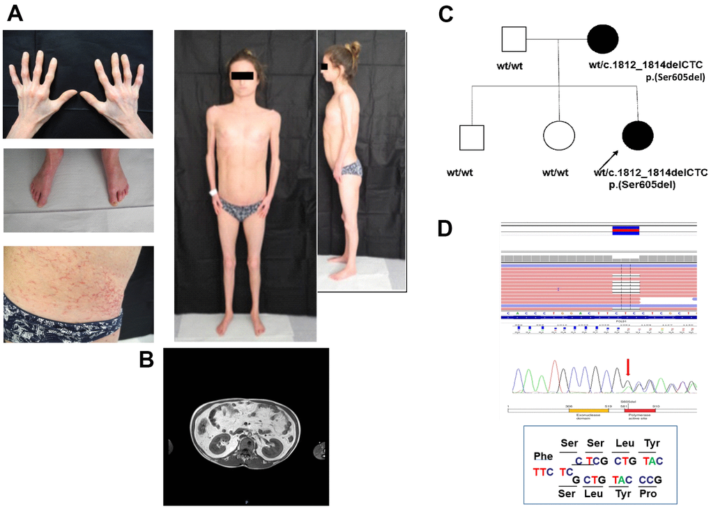 Clinical and molecular diagnosis. (A) Pictures showing patient’s clinical features at the age of 21: telangiectasia and skin scleroderma, minimal subcutaneous adipose tissue and reduced limb muscle mass. (B) MRI of the abdomen shows an over-representation of mesenteric fat. (C) Proband’ family pedigree. Full symbol indicates MDPL affected family members. (D) DNA analysis of the proband by NGS and Sanger sequencing revealed the recurrent heterozygous single amino acid in frame genetic deletion c.1812