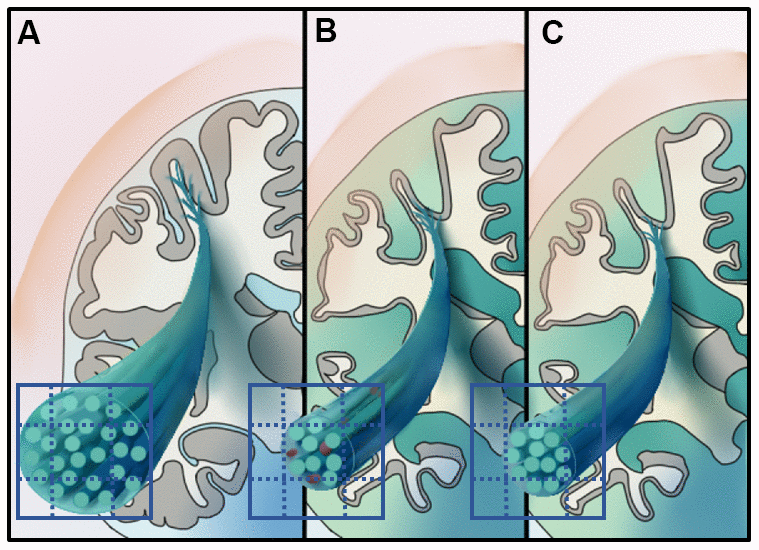 Illustrates the hypothetical model of white matter pathological processes in early-onset Alzheimer’s disease (EOAD) and late-onset Alzheimer's disease (LOAD). Specifically, 3D schematic represents a magnified fiber bundle, green tubule and grid on the cross-section represent the axons and imaging voxels, respectively. (A) Represents the healthy fiber bundle in the aging population. EOAD (B) might undergo white mater disruption involved both the microstructural and macrostructural level, while the macrostructural degeneration dominates white matter loss in LOAD (C).