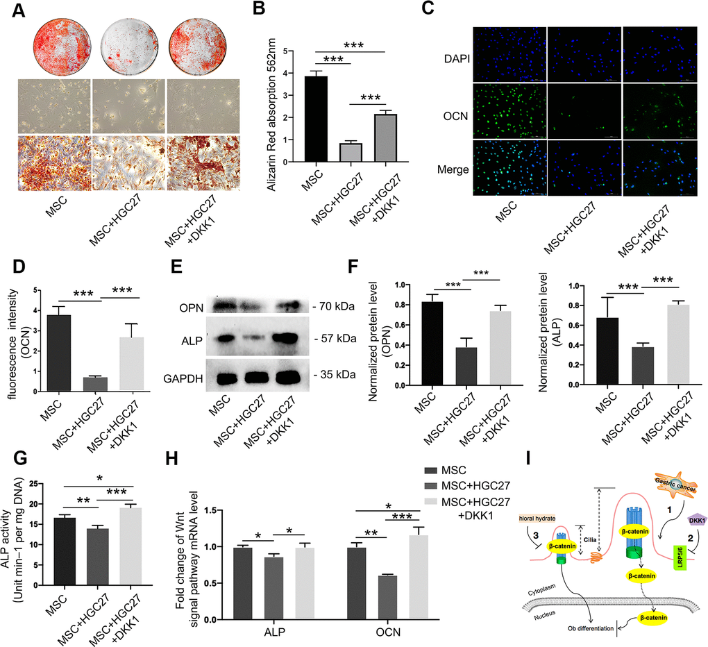 Dkk1 partially rescued bone loss due to gastric cancer. (A) Bone mineralization levels in the MSC, MSC+HGC27, and MSC+HGC27+DKK1 groups were analyzed by alizarin red staining at day 16 post-OS induction. (B) Quantitative mineralization levels based on (A). (C) Immunofluorescence staining of MSC, MSC+HGC27, and MSC+HGC27+DKK1 to visualize OCN (green) and nuclei (blue). Scale bars, 100 μm. (D) Quantitative analysis of the fluorescence intensity in (C). (E) Western blot analysis of OPN and ALP expression in MSC, MSC+HGC27, and MSC+HGC27+DKK1 groups. (F) Quantitative analysis of protein levels in (E). (G) ALP activity in the MSC, MSC+HGC27, and MSC+HGC27+DKK1 groups at day 3 post-OS induction. (H) qRT-PCR results comparing ALP and OCN transcription levels in the MSC, MSC+HGC27, and MSC+HGC27+DKK1 groups on day 3 post-OS induction. Data are shown as mean±SEM. Statistical differences were obtained using One-way ANOVA with post-hoc testing, *, pI) Schematic diagram of the role of the Wnt/β-catenin pathway under normal and gastric cancer conditions.