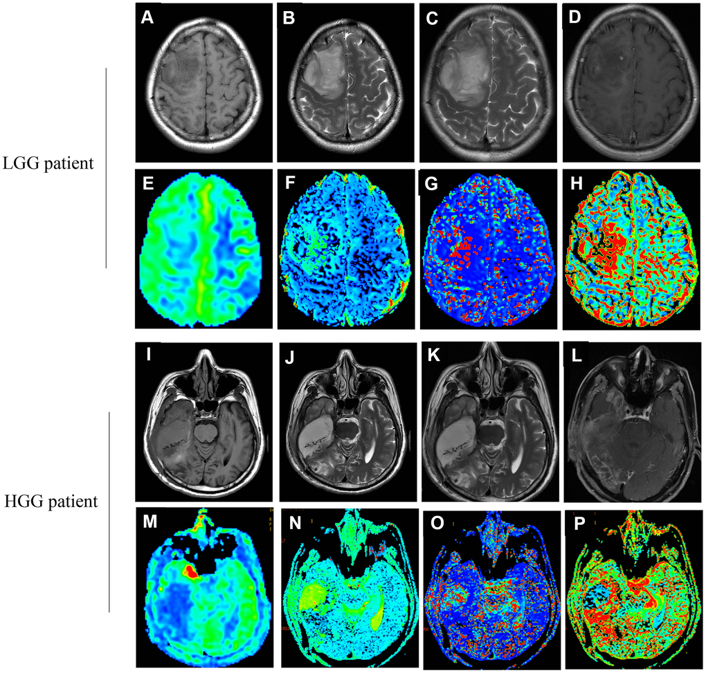 Images (A–H) correspond to a 37-year old female with LGG (WHO grade II, IDH1mut). Images (I–P) correspond to a 47-year old male with HGG (WHO grade IV, IDH1wt). (A, I) The T1 image; (B, J) The T2 image; (C, K) The T2WI image; (D, L) The T1WI+C image; (E, M) The CBF map; (F, N) The D map; (G, O) The D* map; (H, P) The f map. (true diffusion coefficient: (D) perfusion-related diffusion coefficient: D*; perfusion fraction: f; cerebral blood flow: CBF).