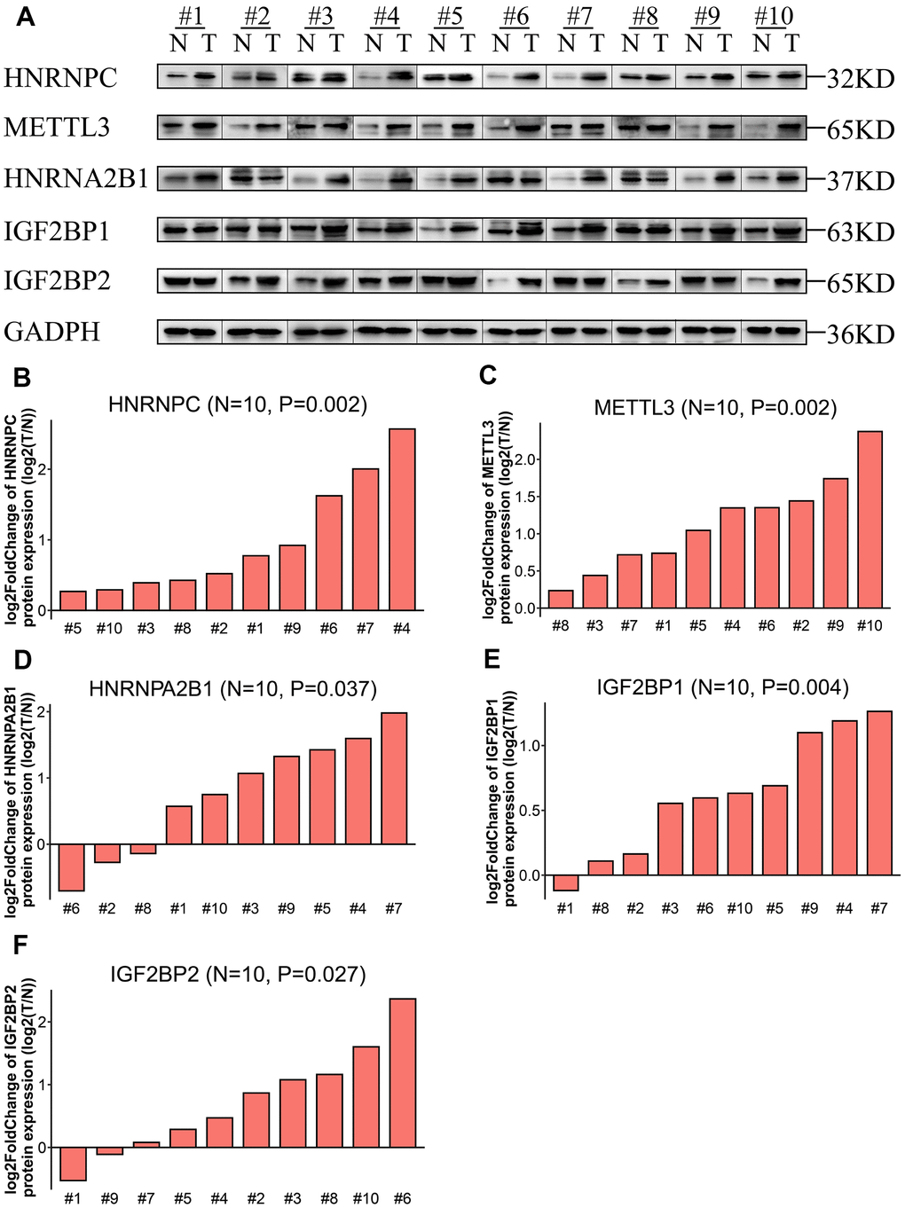 Expression levels of the five prognostic proteins in LADC patient samples. (A) Western blot analysis shows expression levels of IGF2BP1, IGF2BP2, HNRNPA2B1, HNRNPC, and METTL3 proteins in 10 paired normal lung and LADC tissue samples. (B–F) Relative expression levels of the five potentially prognostic m6A regulatory proteins, namely, IGF2BP1, IGF2BP2, HNRNPA2B1, HNRNPC, and METTL3 in 10 LADC tissues. GAPDH was used as loading control. The values were normalized by log2 fold change (ratio of tumor to normal tissue expression) of the target proteins.