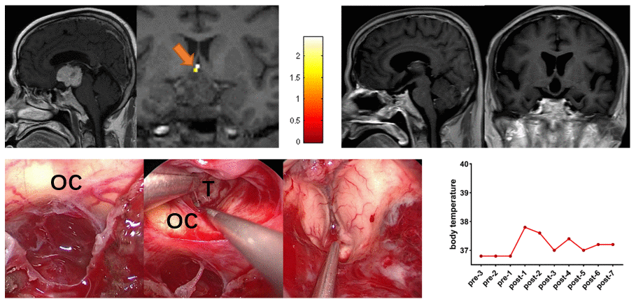 Preoperative midsagittal contrast-enhanced T1-weighted MRI scans showed a large solid tumor involving the third ventricle, and the coronal task-related fMRI showed the activated POAH of the hypothalamus in case 12. The orange arrow indicated the activated POAH. The postoperative sagittal and coronal contrast-enhanced T1-weighted MRI showed that GTR was achieved. Intraoperative photographs showed that the tumor was removed through the CPC approach combined with the EETLT approach. After complete resection of the tumor, the midbrain aqueduct and hypothalamus could be observed. No significant increase in body temperature was observed during the perioperative period. fMRI: functional magnetic resonance imaging; POAH: preoptic and anterior hypothalamic region; GTR: gross total resection; CPC: chiasm-pituitary corridor; EETLT: endoscopic endonasal trans-lamina terminalis approach; OC: optic chiasma; T: tumor.