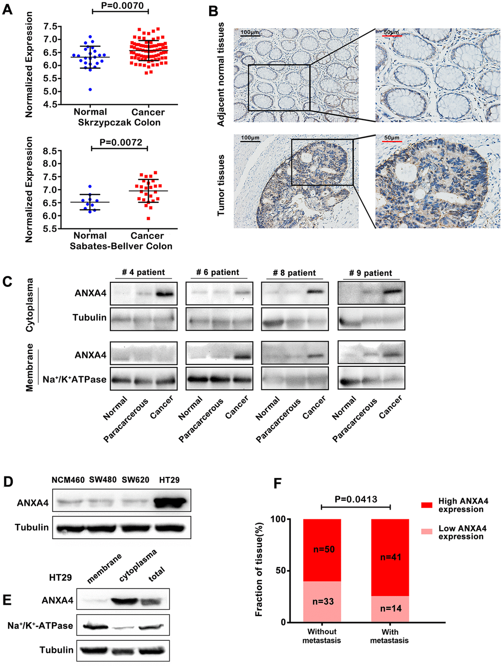 Membrane-cytoplasm translocation of ANXA4 in CRCA. (A) ANXA4 mRNA expression levels were significantly higher in colorectal cancer tissue samples than in normal tissue samples, as indicated by analysis of the Oncomine colorectal cancer dataset, Skrzypczak Colorectal dataset and Sabates-Bellver Colon dataset. (B) Representative images of the protein expression of ANXA4 in CRC and tumour-adjacent tissue samples (n=138) generated by immunohistochemistry. (C) Representative blots of the membrane and cytoplasmic protein expression of ANXA4 in CRC and tumour-adjacent tissue samples (n=19) generated by western blotting. Tubulin was used as the loading control for total protein; Na+/K+-ATPase was used as the loading control for cell membrane protein. (D) The expression of ANXA4 in normal colon cells (NCM460) and colorectal cancer cells (SW480, SW620, and HT-29 cells) determined by western blotting. Tubulin was used as the loading control for total protein. (E) The membrane and cytoplasmic protein expression levels of ANXA4 in HT-29 cells determined by western blotting. Na/K-ATPase was used as the loading control for cell membrane protein; Tubulin was used as the loading control for total protein. (F) Correlation analysis between high ANXA4 expression and metastasis in CRC patients (n=138) by chi-square test analysis (p