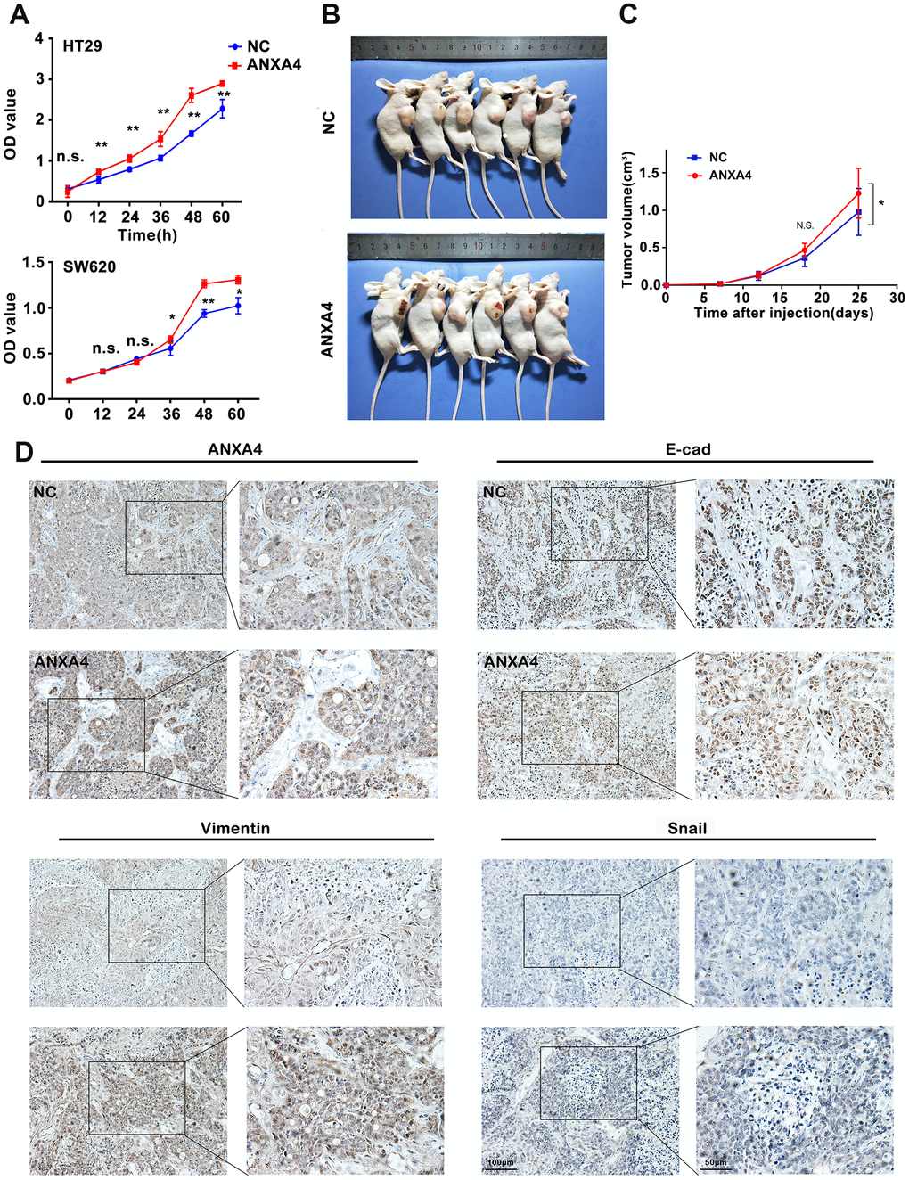 ANXA4 promotes tumorigenesis and EMT in a xenograft model. (A) CCK8 assay assessing the viability of HT-29 cells transfected with HA-ANXA4. The data are shown as the mean ± SEM of three independent experiments. *p B) HT-29 cells stably transfected with ANXA4 were subcutaneously injected into six nude mice (2×106/120 μl per mouse). After 25 days, the mice were sacrificed, and the tumours were removed. (C) Tumour growth curves of the xenograft tumours (n=6). Tumour volume was calculated at different time points (7, 12, 18, and 25 days) using the formula V=(a×b2)/2. *p D) Protein expression levels of ANXA4 and the EMT-related molecules E-cadherin, Vimentin, and Snail in tumours determined by IHC.
