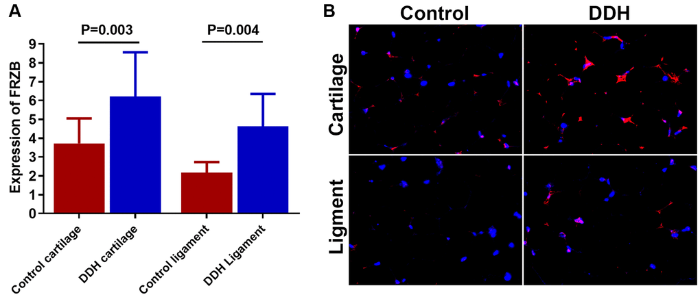 Tissue expression of FRZB in patients and controls. (A) DDH patients were found to have significantly higher expression of the FRZB in the articular cartilage and ligament as compared with the controls (2.43 ± 1.65 vs 4.05 ± 1.89, p = 0.002 for articular cartilage; 2.46 ±1.68 vs. 3.85 ± 2.73, p = 0.007 for joint ligament). (B) Immunofluorescent assay of FRZB (red) expression and nucleus (blue) in the cartilage and ligament tissues in different groups of patients observed under confocal microscopy.