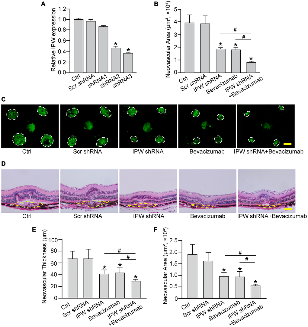 Silencing of lncRNA-IPW inhibits experimental choroidal neovascularization in vivo. (A) C57BL/6 mice received an intravitreal injection of scrambled (Scr) shRNA, IPW shRNA, or left untreated (Ctrl). qRT-PCRs were conducted to detect IPW expression at day 14 after intravitreal injection (n = 6 animals/group; Kruskal-Wallis test). (B–F) C57BL/6 mice received an intravitreal injection of Scr shRNA, IPW shRNA3, bevacizumab, IPW shRNA3 plus bevacizumab, or left untreated (Ctrl). After 14 days, the mice were euthanized and the RPE/choroid complexes were dissected and flat-mounted. The blood vessels were stained by Isolectin-B4 and neovascular area was calculated (B; n = 6 animals/group; Kruskal-Wallis test). (C) The representative images of Isolectin-B4 staining were shown on day 14 after laser photocoagulation. Green staining indicated the CNV lesion. Dashed lines delineate the lesions. Scale bar: 200 μm (C). (D–F) Histological sections of HE stained retinal sections from mice on day 14 after laser photocoagulation. Typical sections of laser-burned eye stained with HE, with the lesion delineated by the dashed line (D). Neovascular degree was estimated by neovascular thickness (E; n = 6 animals/group; Kruskal-Wallis test) and neovascular area (F; n = 6 animals/group; Kruskal-Wallis test). Scale bar: 100 μm. *P #P 