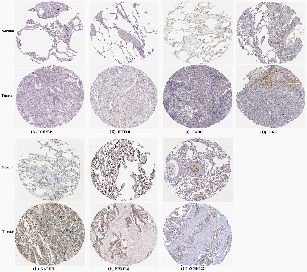 Verification of hub RBPs expression in LUAD and normal lung tissue using the HPA database. (A) IGF2BP1, (B) IFIT1B, (C) PABPC1, (D) TLR8, (E) GAPDH, (F) PIWIL4, (G) ZC3H12C.