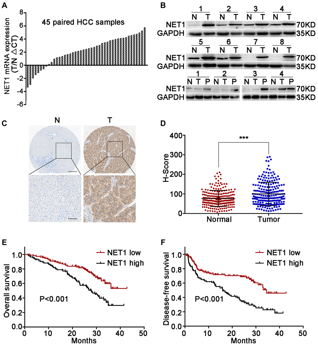 Upregulation of NET1 in HCC tissues is associated with clinical prognosis. (A) NET1 mRNA levels in 45 pairs of N and T tissues were determined by real-time PCR. Expression of NET1 was normalized to that of GAPDH. (B) NET1 protein levels in 8 pairs of N and T tissues, and in 4 pairs of N, T and P tissues were determined by Western blot; GAPDH was used as a loading control. (C) Immunohistochemistry staining of NET1 in paired N and T tissues from two patients. Scale bars, 250 μm; 100 μm. (D) H-scores of NET1 staining intensity in N (n = 210) and T (n = 210) tissues. (E and F) Kaplan–Meier analysis of overall survival (E) and disease-free survival (F) using tissue microarray (TMA) data of 210 patients. N, non-carcinoma normal tissues; T, tumor tissues; P, portal vein tumor thrombus tissues. ***P 
