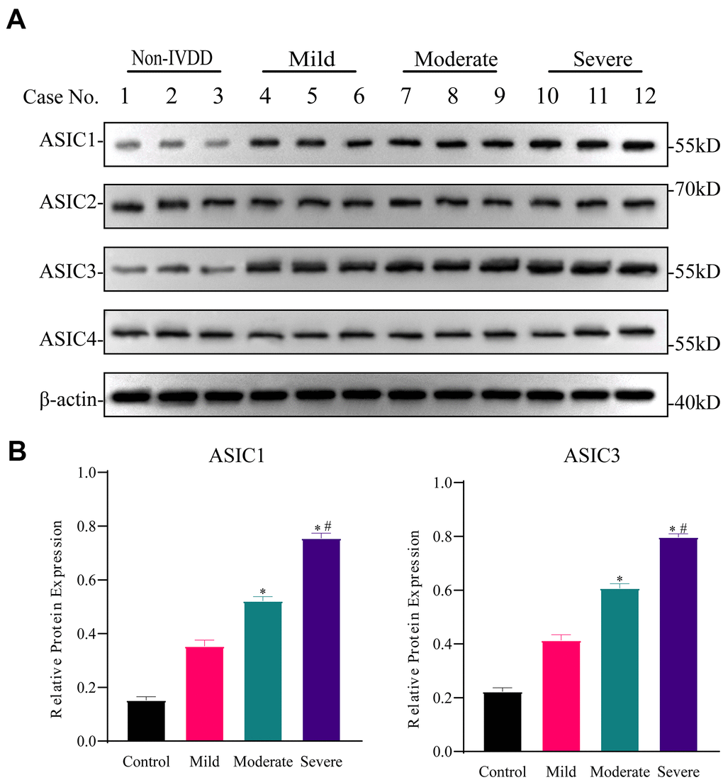 Differential expression of ASICs in freshly isolated human IVD tissues with different degrees of intervertebral disc degeneration (IVDD). (A) Representative Western blotting analyses of ASICs 1-4 in IVD tissues from non-IVDD and IVDD groups from mild to severe cases. (B) Analyses of the relative expression of ASIC1 and ASIC3 determined for all patient IVD tissues (n=3 for each group) using densitometric analysis of Western blotting as per (A). Data are mean ± SD. * indicates P≤0.05 compared to non-IVDD group; # indicates P≤0.05 compared to mild group.