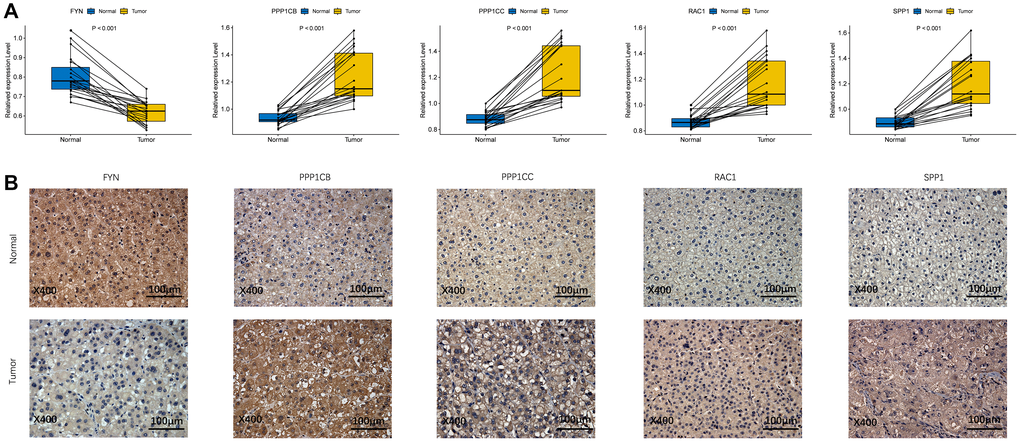 The expression of prognostic genes between HCC and adjacent non-tumorous tissues. (A) mRNA expression analysis by qRT-RCR. (B) Protein expression analysis by IHC.