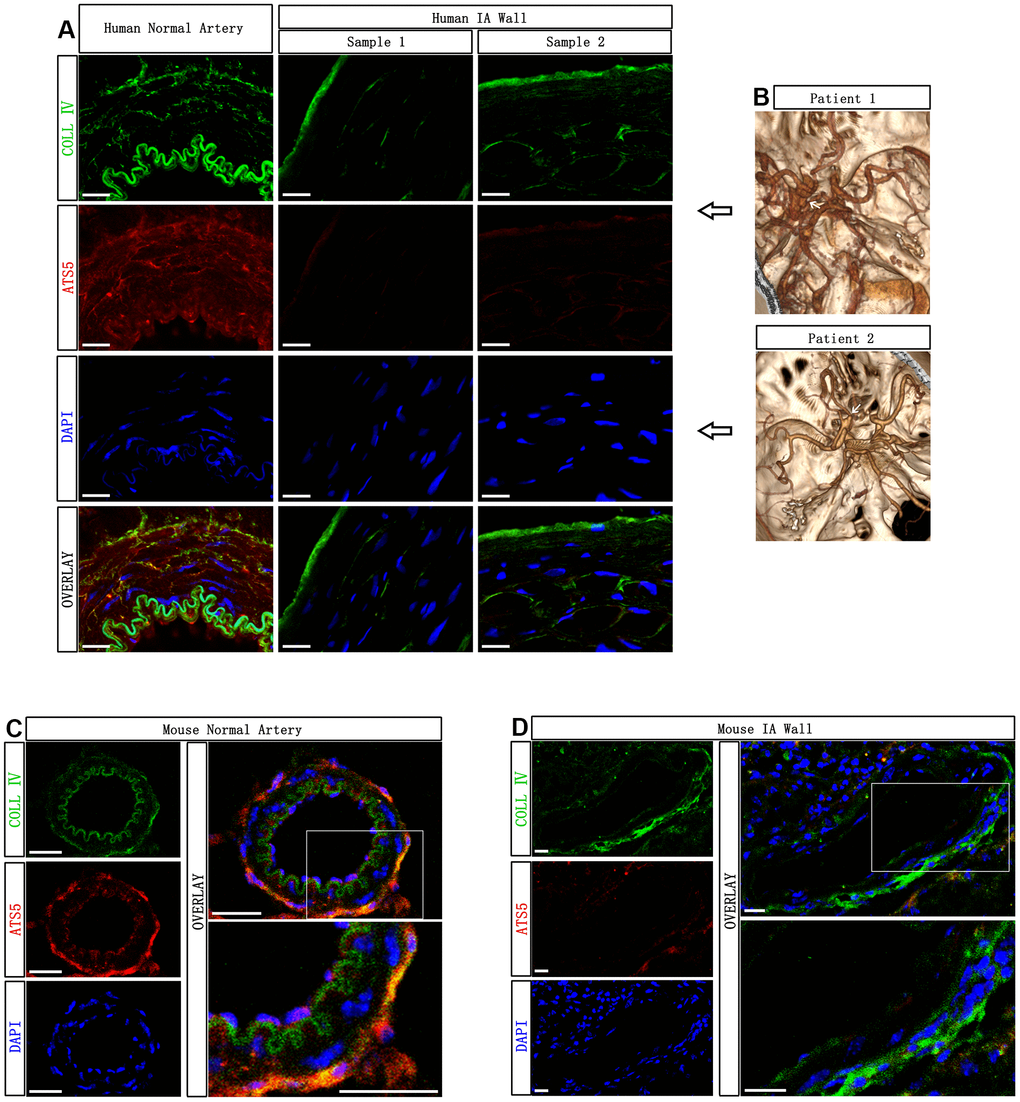 Decreased presence of ADAMTS-5 within the aneurysmal wall. (A) Representative immunofluorescence performed on intracranial aneurysm samples harvested from human IA patients after microsurgical clipping, and the normal cerebral artery harvested from a human brain trauma patient, showing the presence of ADAMTS-5. ADAMTS-5 and Collagen IV are displayed in red and green, respectively. Scale bars: 20 μm. (B) CTA identification of aneurysms from the patients included in this study. Human IA sample 1 and sample 2 were obtained from IA patient 1 and patient 2, respectively. (C, D) Representative immunofluorescence performed on mouse samples displaying the healthy control artery and aneurysmal artery for ADAMTS-5. Scale bars: 20 μm. ATS5, ADAMTS-5; COLL IV, Collagen IV.