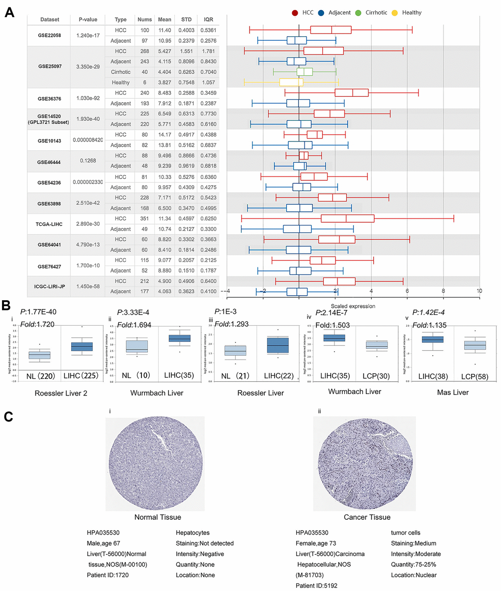 PPM1G expression is significantly upregulated in LIHC. (A) Chart and box plot showing PPM1G expression in normal and LIHC tissues (HCCDB). (B) Box plot comparing PPM1G mRNA expression in normal (left plot) and cancer tissues (right plot) generated using Roessier Liver2 (i), Wurmbach Liver (ii), and Roessier Liver2 (iii) data (Oncomine). Box plots comparing PPM1G mRNA expression in cancer tissues (left plot) and liver cancer precursor tissues (right plot) using the Wurmbach Liver (iv) and Mas Liver (v) datasets, respectively (Oncomine) (p-value of 1E−4, fold-change of 2, and gene ranking of 10%). (C) PPM1G protein expression in normal (i) and LIHC tissues (ii) (HPA).