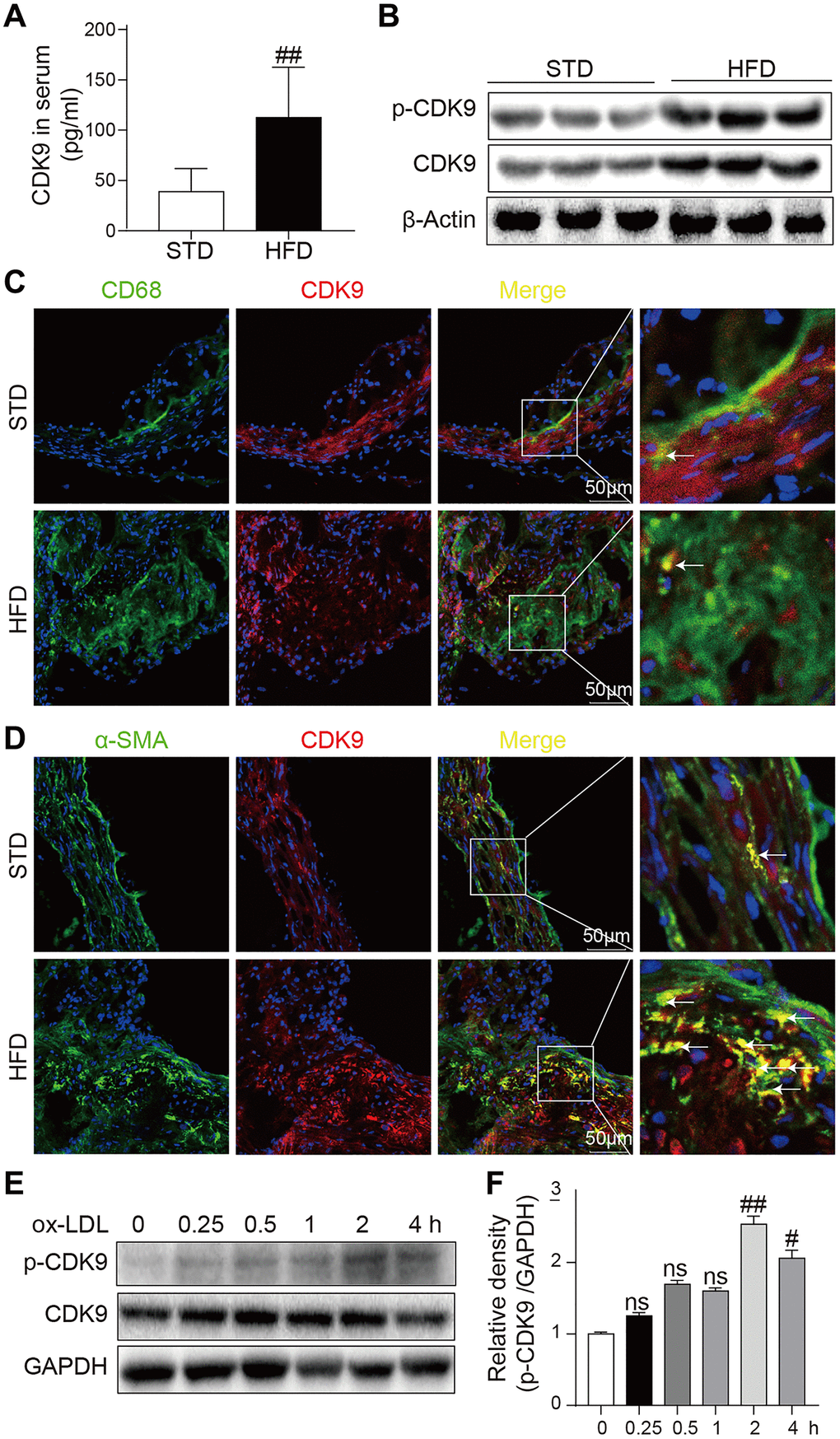 CDK9 is expressed in VSMCs in atherosclerotic lesions. (A) Serum levels of CDK9 were detected using ELISA assay (n = 8; **P B) p-CDK9 and CDK9 protein levels in aortas of ApoE-/- mice were detected by western blotting. (C) Representative immunofluorescence staining of CDK9 (red) and macrophage marker CD68 (green). Tissues were counterstained with DAPI (blue). Yellow arrows indicate co-location of CDK9 and CD68 stanning (scale bar = 50 μm). (D) Representative immunofluorescence staining of CDK9 (red) and VSMCs marker α-SMA (green). Tissues were counterstained with DAPI (blue). Yellow arrows indicate co-location of CDK9 and α-SMA stanning (scale bar = 50 μm). (E, F) Western blot analysis of p-CDK9 and CDK9 protein levels in VSMCs challenged with 50 μg/ml ox-LDL for the indicated time points (n = 8; ##P 