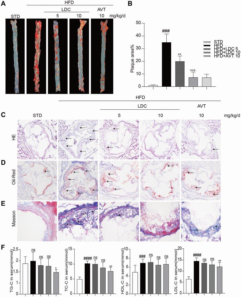 CDK9 inhibitor reduces indices of atherosclerotic lesions in ApoE-/- mice fed with HFD. (A–B) Representative en face Oil Red O staining and quantification of Oil Red O-positive lipid area in the aorta (n = 8; ###p ***p C) Photomicrographs showing representative H&E staining of atherosclerotic lesions (scale bar = 500 μm). (D) Oil Red O staining of atherosclerotic lesions in the aortic root (scale bar = 500 μm) and quantification lesions area highlighted by Oil Red O staining. (E) Representative images of Masson’s Trichome staining for collagen deposition (scale bar = 50 μm). (F) Serum levels of TG, TC, LDL and HDL (n = 8; #P ##P ###p *P **P 