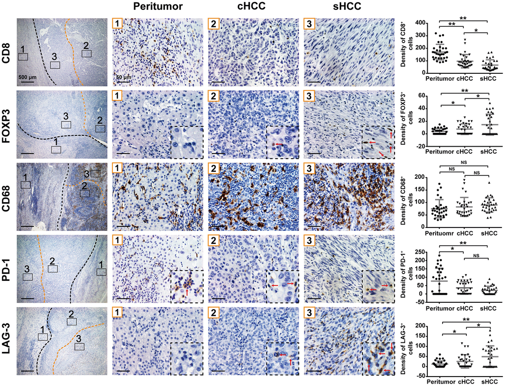 CD8+, FOXP3+, CD68+, PD-1+, and LAG-3+ cell densities (cells/mm2) in the sarcomatoid components, conventional HCC components and peritumor components are shown. Graph: cell densities of each region are indicated in dot plot. *p