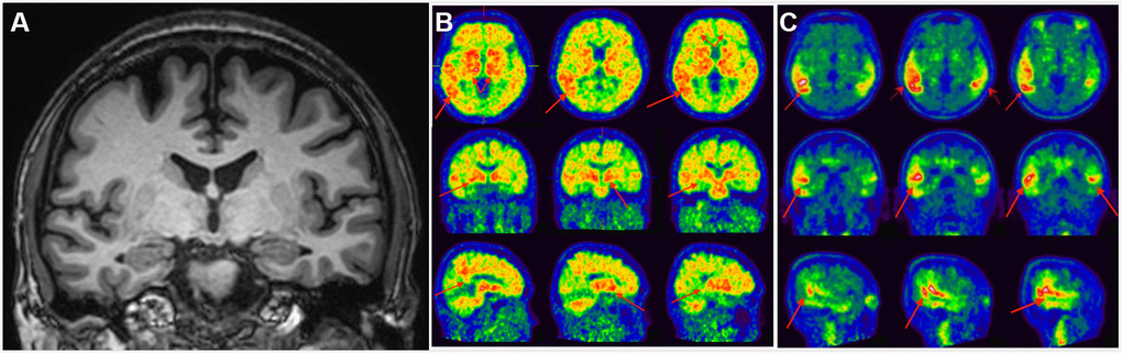 Clinical utility of AD-RAI in MCI subjects. A 50-year-old man with 16-year education had complaints of impaired short-term memory for 4 years. Z-score in Trial 4 of HKLLT was -2.97 SD (≤ -1 SD, i.e. MCI). The average visual MTA rating score was 0 suggestive of non-AD (A). HV measures also suggested non-AD, with a normal raw HV of 7.25mL (> 6.07mL) and HF of 0.48% (> 0.41%). However, AD-RAI was 0.68 (> 0.5) suggestive of AD. Subsequent PIB PET (B) and T807 PET (C) confirmed PIB and T807 retention, respectively (red arrows). The final diagnosis of this subject was prodromal AD. Abbreviations: AD-RAI=Alzheimer’s disease resemblance atrophy index; MCI=mild cognitive impairment; MTA=medial temporal lobe atrophy; HKLLT=Hong Kong List Learning Test; SD=standard deviation; MRI=magnetic resonance imaging; HV=hippocampal volume; HF=hippocampus fraction; PET=positron emission tomography; SVD=small vessel disease.