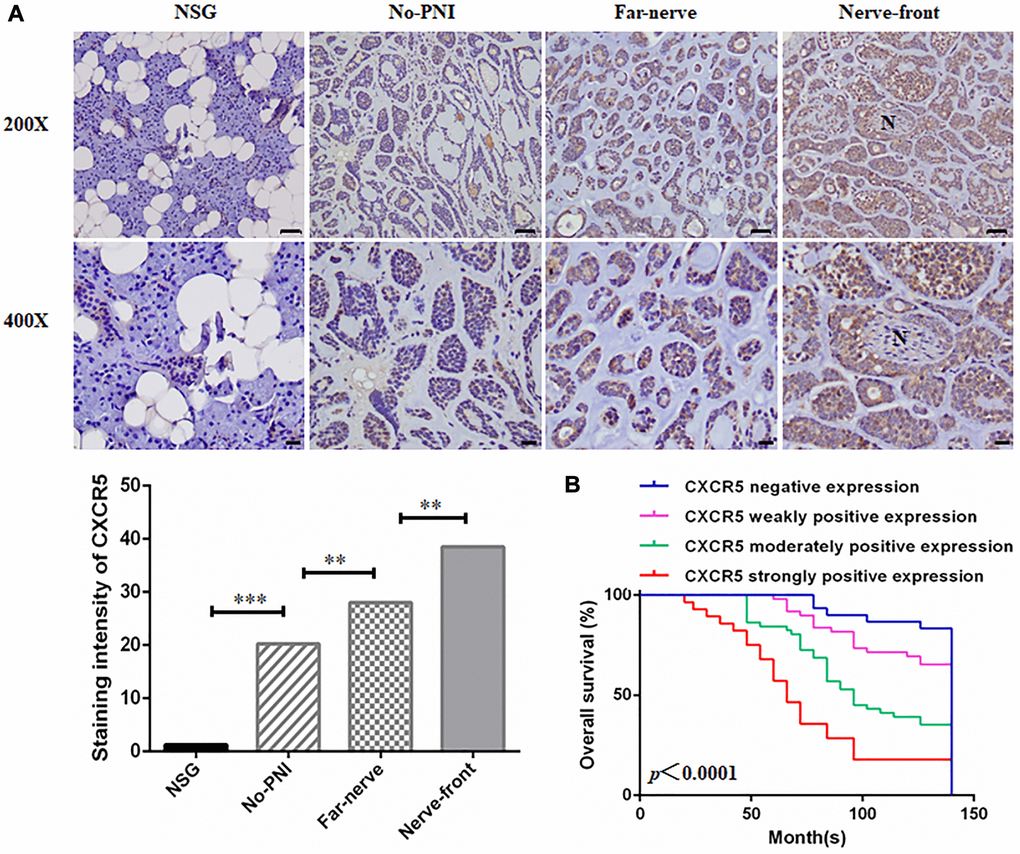 Clinical significance of CXCR5 expression in SACC patients. (A) Immunohistochemical staining of CXCR5 in normal salivary gland (NSG), SACC without PNI (No-PNI), far away from nerve of SACC with PNI (Far-nerve), nerve invasion front of SACC with PNI (Nerve-front). ‘N’ represented nerve. (Bar: upper, 50 μm; lower, 20 μm) (**p ***p B) Kaplan-Meier survival analysis on SACC patients with different expression status of CXCR5. The overall survival time for patients without or with low CXCR5 expression was longer than those with high CXCR5 expression (log-rank test, p 