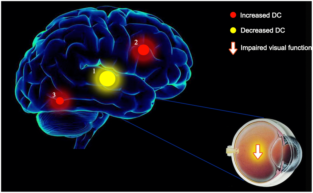 The mean DC values of altered brain regions. Compared with the HCs, the DC values of the following regions were decreased to various extents: 1- left ITG (BA 55, t = -5.1646). Compared with the HCs, the DC values of the following regions were increased to various extents: 2- left SMA (t = 4.68734), 3- right fusiform (t = 4.6357). Abbreviations: DC, Degree centrality; HCs, healthy controls; BA, Brodmann's area;ITG, inferior temporal gyrus; SMA, supplementary motor area.