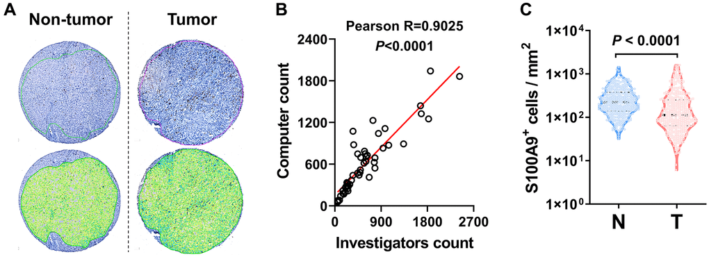 S100A9 expression in HCC tumor. (A) Representative images of IHC staining. (B) Scatter plot illustrating the correlation between S100A9-expressing cell counts in HCC by computer counting and investigator counting. (C) Quantification of S100A9+ cell densities in the N (nontumoral) and T (tumoral) regions (n = 382), and the Wilcoxon matched-pairs signed-rank test was used to analyze the nonparametric test between the paired two groups.