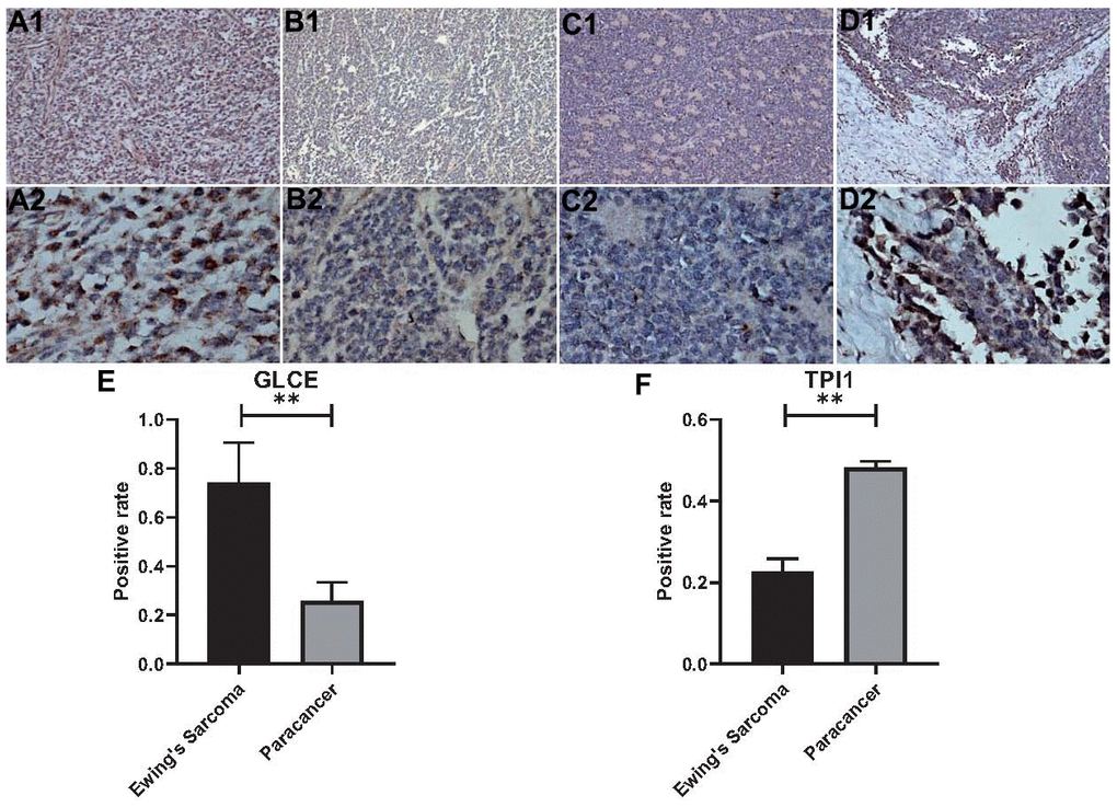 Statistical analysis of immunohistochemistry and positivity rate. (A1, A2) Show 100x magnification and 400x magnification of GLCE expression in cancerous tissue. (B1, B2) Show 100x magnification and 400x magnification of GLCE expression in paraneoplastic tissue. (C1, C2) Show 100x magnification and 400x magnification of TPI1 expression in cancerous tissue. (D1, D2) Show 100x magnification and 400x magnification of TPI1 expression in paraneoplastic tissue. (E) Indicates the statistical results of the positive rate of all immunohistochemical pictures of GLCE, “**” indicates P F) Indicates the statistical results of immunohistochemical positivity rate for all TPI1, “**” indicates P 