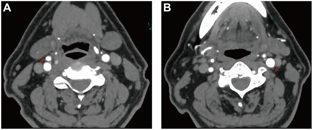 Pericarotid fat density analysis. Two regions of interest (3 mm2 in diameter) were placed in the pericarotid fat surrounding the origin of the internal carotid artery. (A) right internal carotid artery. (B) left internal carotid artery.