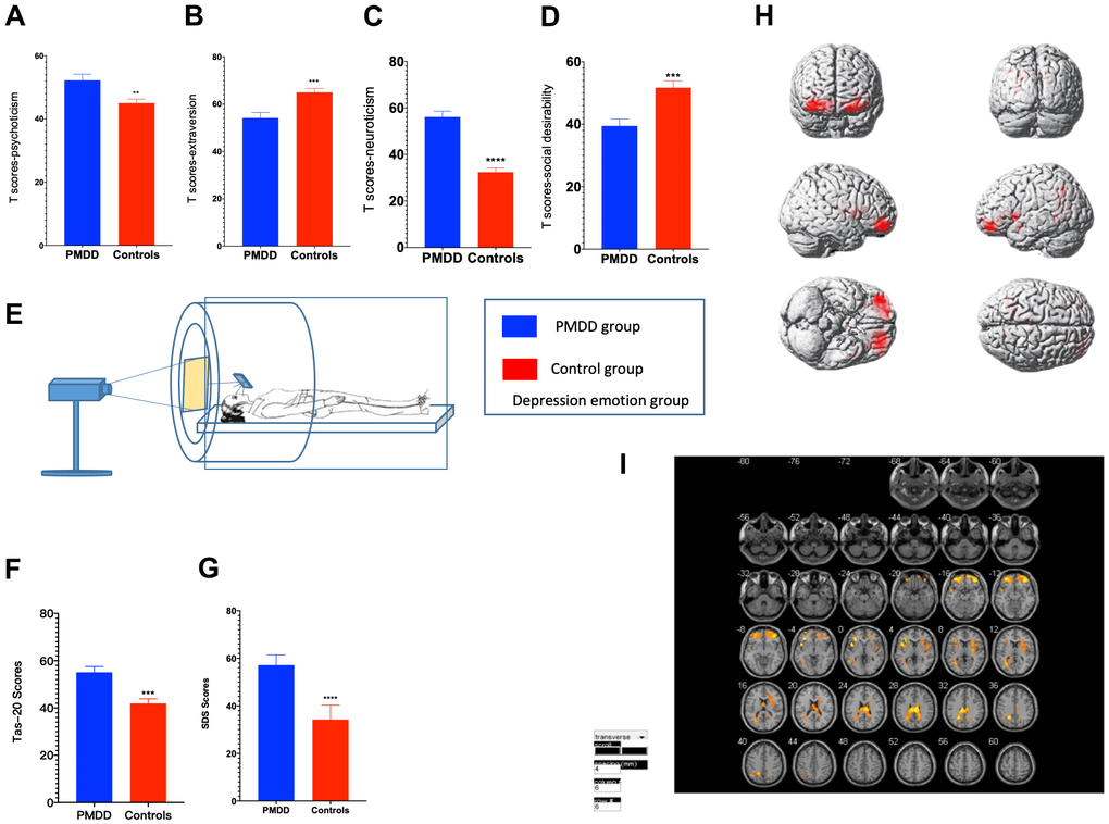 Comparisons of emotional changes and brain reactivity to emotional stimuli among PMDD and control study participants (PMDD=19, Controls=21) of the depression-induced group. (A–D) Extraversion, psychoticism, neuroticism, and social desirability T-scores. (E) Schematic presentation of participants in the experiment. (F) TAS-20 scores for both groups. (G) Depression emotions of participants in the depression-induced group. (H) Illustration of activations in various brain areas: the middle frontal gyrus, middle gyrus and cingulate gyrus for PMDD and HC groups. (I) PMDD and HC groups Depression mood Subtract Neutral Frontal Mid-Back Picture Condition T-test activation Differential area; p  389 warm (T value positive) represents PMDD group higher than the HC group, cool (T negative) on behalf of the normal group than the patient group.