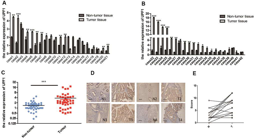 High expression of UPF1 in EEC: (A, B) 28 (66.7%) of 42 EEC patients had high expression of UPF1. In 5 of 42 cases (11.9%), the expression level was lower than normal tissues. Of the 42 cases, 9 had no significant difference with normal tissues. (C) Overall analysis the high expression of UPF1 in EEC is of great significance. (D) Immunohistochemical results showed that the positive rate of 17 (80.95%) of the 21 patients (T) was higher than that of the normal control group (N). The positive rate of 4 cases (T) (19.05%) was lower than that of the normal control group (N)(NIKON, 200X). (E) Scoring of immunohistochemistry. Data was represented as the mean +/- SEM.*P