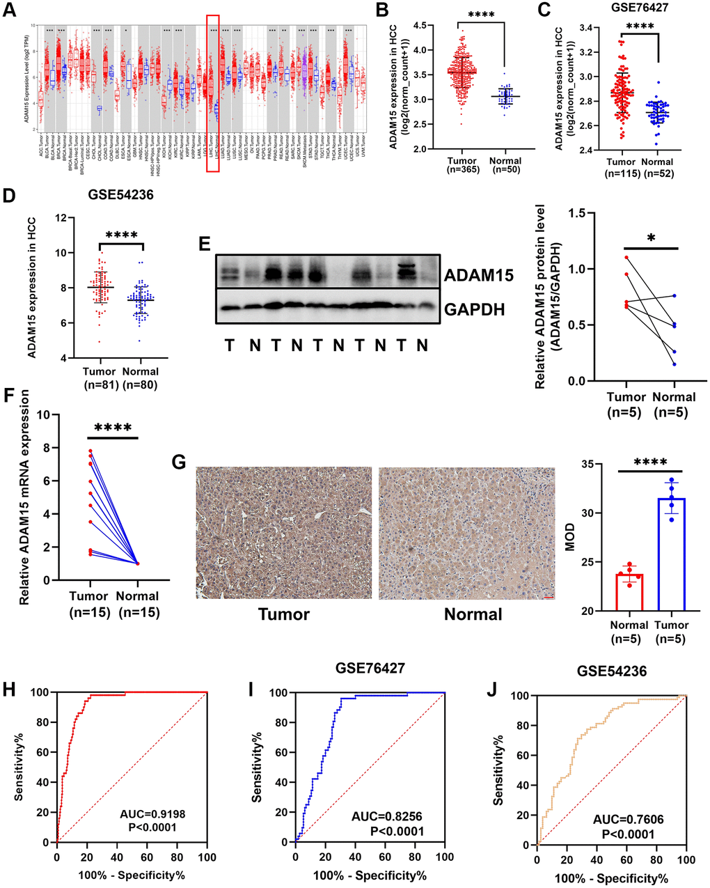 Different expression of ADAM15 in HCC tissues and corresponding noncancerous tissues. (A) ADAM15 expression in pan-cancer. (B) ADAM15 expression was up-regulated in HCC tissues compared with paired noncancerous tissues by the TCGA database. (C, D) The level of ADAM15 expression was higher in HCC tissues than that in matched noncancerous tissues by the GEO database (GSE76427 and GSE54236). (E) ADAM15 expression in HCC samples and paired noncancerous samples was confirmed by western blot, and higher ADAM15 expression was in HCC tissues compared with matched noncancerous tissues. (F) ADAM15 expression in HCC samples and paired noncancerous samples was verified by RT-qPCR, and higher ADAM15 expression was in HCC tissues compared with matched noncancerous tissues. (G) ADAM15 expression in HCC samples and paired noncancerous samples was confirmed by IHC, and the value of MOD was higher in HCC tissues compared with matched noncancerous tissues. Magnification, ×200. Scale bar: 50 μm (H, I, J) Validation of diagnostic value of ADAM15 overexpression in HCC based on the TCGA and GEO databases.